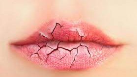 تشقق الشفاه في الشتاء.. أسباب شائعة ونصائح للوقاية والعلاج