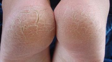 أبرزها الغدة الدرقية.. عوامل خفية وراء تشقق الكعب