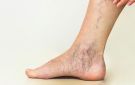 لعلاج دوالى القدمين في المنزل .. جرب هذه النصائح