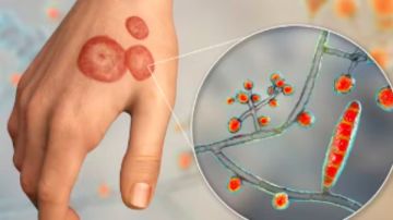 ارتفاع درجات الحرارة وتغير المناخ يزيد من انتشار الأمراض الفطرية بين البشر