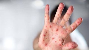 481 حالة خلال 3 أيام.. الحصبة تهدد سكان تكساس ونيو مكسيكو بأمريكا