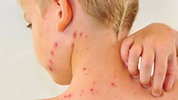 تفشي الحصبة في الولايات المتحدة.. والمستشفيات تستقبل مئات المصابين تفشي الحصبة في الولايات المتحدة.. والمستشفيات تستقبل مئات المصابين