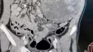 ورم في الكلية .. تدخل طبي عاجل لإنقاذ طفلة في المنوفية