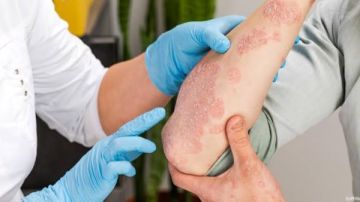 الإكزيما مرض جلدي مزمن.. تعرف على الأسباب والأعراض والعلاج الإكزيما مرض جلدي مزمن.. تعرف على الأسباب والأعراض والعلاج