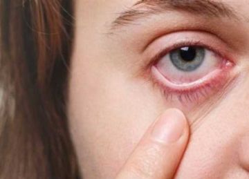 لمرضى حساسية العين.. 3 نصائح ضرورية مع طقس غدا المحمل بالأتربة