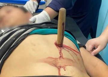 فريق طبي بمستشفى المنصورة الدولي ينقذ حياة طفل أصيب بطعنة نافذة بالبطن