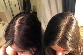 تساقط الشعر.. الأسباب الأكثر شيوعا وطرق العلاج والوقاية