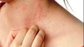 حمو النيل لدى الأطفال .. كيفية التخلص والوقاية منه