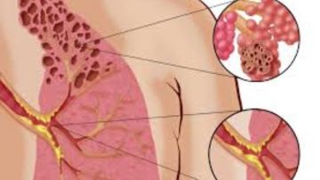 تحذيرات من مرض رئة الفشار.. حالة نادرة وخطيرة تهدد الجهاز التنفسي