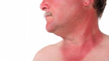 أكلة شهيرة تمنع حروق الشمس والسرطان.. فما هي؟! أكلة شهيرة تمنع حروق الشمس والسرطان.. فما هي؟!