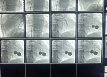نجاح فريق طبي في جراحة دقيقة لاستبدال الصمام الميترالي لمريضة بالإسكندرية (صور)