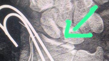 الدقهلية: إنقاذ يد مريض من البتر بمستشفى السنبلاوين