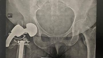 زراعة مفصل صناعي مزود بجزع خاص لامرأة بمستشفى الهلال