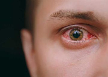 مع حرارة الصيف وموجات الغبار.. 7 نصائح لعلاج التهابات العيون والوقاية منها