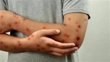 زامبيا تسجل 75 إصابة بمرض جدري القردة منذ بداية ظهور المرض زامبيا تسجل 75 إصابة بمرض جدري القردة منذ بداية ظهور المرض