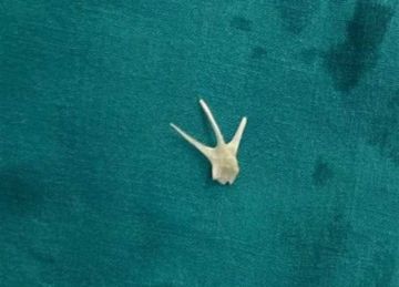 استخراج شوكة سمكة من القصبة الهوائية لطفل بـ سوهاج دون مضاعفات