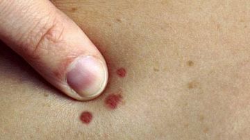 علامات بسيطة على بشرتك قد تشير إلى الإصابة بالسرطان