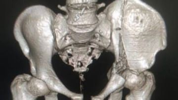 مستشفى 15مايو .. جراحة نادرة تعيد الحياة لمريض بعد علاج مفصل الحوض