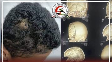 اخترق مسمار رأسه.. أطباء الفيوم الجامعي ينقذون طفلا من الموت