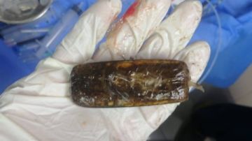 ابتلعه منذ عامين.. فريق طبي بمستشفى الأزهر بأسيوط يستخرج هاتفا محمولا من بطن مريض