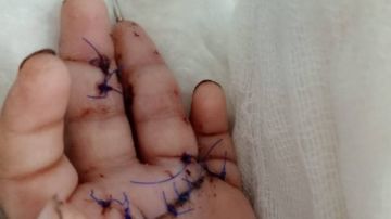 جامعة الزقازيق: نجاح زراعة أصابع رضيع مبتورة واستعادة وظيفتها بصورة كاملة شاهد