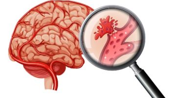 جهاز طبي.. ابتكار جديد في علاج السكتات الدماغية تفاصيل