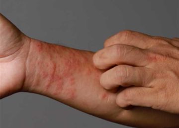 من الكمادات الباردة إلى الصبار.. 3 علاجات منزلية للطفح الحراري