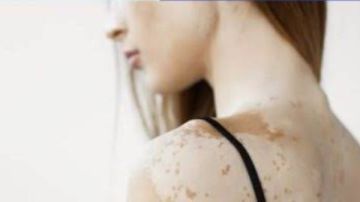 فئات معينة أكثر عرضة للإصابة بالبهاق .. هل أنت منهم؟