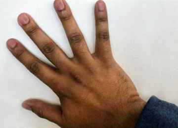 هل تعاني من البقع الداكنة في مفاصلك أو ركبتيك؟.. 4 خطوات تخلصك من الإحراج