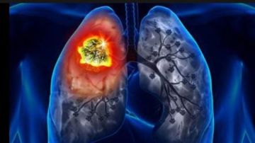 خلى بالك.. علامات سرطان الرئة وأعراض انتشاره في الجسم