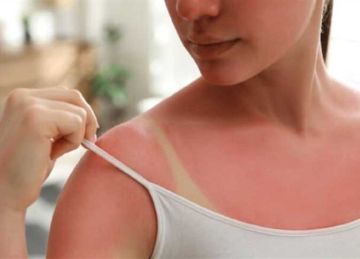 خلال الصيف.. هل الصبار يعالج حروق الشمس؟