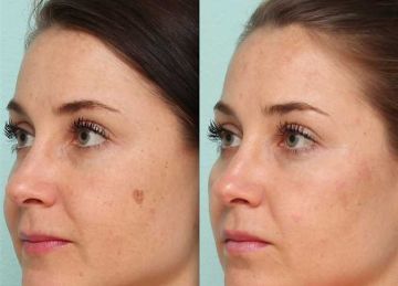 لإشراقة بشرتك.. 5 طرق فعالة للتخلص من البقع الداكنة