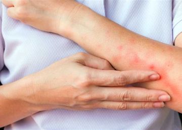 بعد لدغات الناموس .. علاجات منزلية فعالة تخلصك من الحكة والتورم