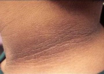 اسمرار الرقبة ليس قلة نظافة.. قد تكون مصاب بهذا المرض