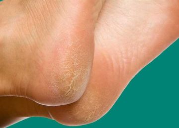 في الصيف.. 7 طرق فعالة للتخلص من تشققات الكعبين واستعادة نعومة القدمين