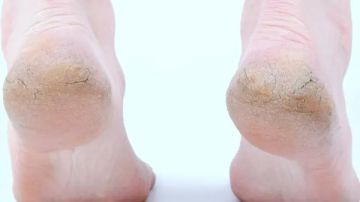 تشقق الكعبين.. الأسباب والأعراض وطرق الوقاية تشقق الكعبين.. الأسباب والأعراض وطرق الوقاية