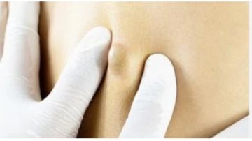 كيس دهني في البطن... كل ما تود معرفته عن المرض كيس دهني في البطن... كل ما تود معرفته عن المرض