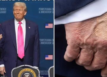 مكياج ترامب.. إجراء تجميلي أم غطاء لأعراض مرضية؟