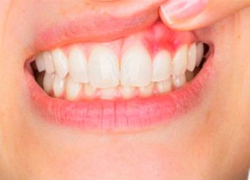 دون الذهاب لطبيب الأسنان.. 5 طرق للتخلص من حساسية اللثة في المنزل دون الذهاب لطبيب الأسنان.. 5 طرق للتخلص من حساسية اللثة في المنزل