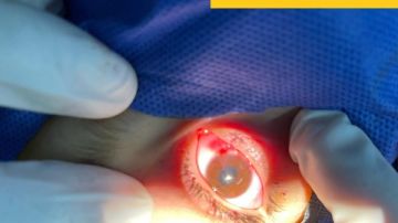 إنقاذ طفل بعد انفجار بمقلة العين في تدخل جراحي عاجل برمد الزقازيق