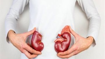 احمي نفسك .. اعرف أسباب الإصابة بسرطان الكلى وأهم علاماته