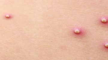 استشاري يحذر: انتشار الحبوب الجلدية علامة على تعب الكلى