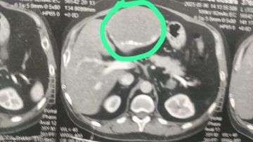 فريق طبي بمركز أورام طنطا ينجح في استئصال وحمة ضخمة من كبد مريض
