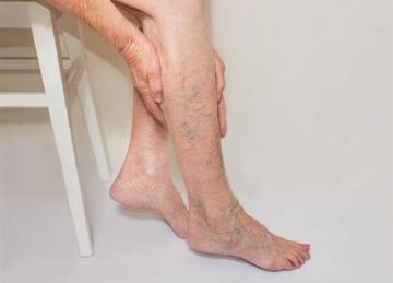 لتجنب التدخل الجراحي.. أبرز علامات دوالي الساقين لتكتشفها مبكرا