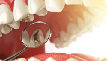 حارب تسوس الأسنان بتناول هذا الفيتامين.. نتائجه مذهلة تفاصيل