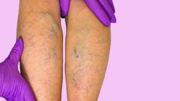 وداعا للدوالي دون عمليات.. طرق فعالة لعلاج دوالي الساق في المنزل وداعا للدوالي دون عمليات.. طرق فعالة لعلاج دوالي الساق في المنزل