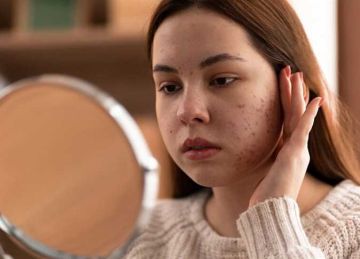 تجنبها للحصول على بشرة صافية.. 5 أطعمة تزيد من حب الشباب في الصيف