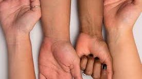 3 أسباب مرضية وراء اسمرار البشرة .. افحص نفسك 3 أسباب مرضية وراء اسمرار البشرة .. افحص نفسك