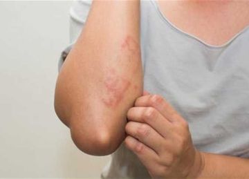 أبرزها ماء الورد ومكعبات الثلج .. 4 علاجات طبيعية لتخفيف الطفح الجلدي