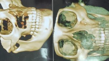 بإشادة وزارة الصحة.. استئصال ورم معقد من وجه سيدة بمستشفى قنا العام